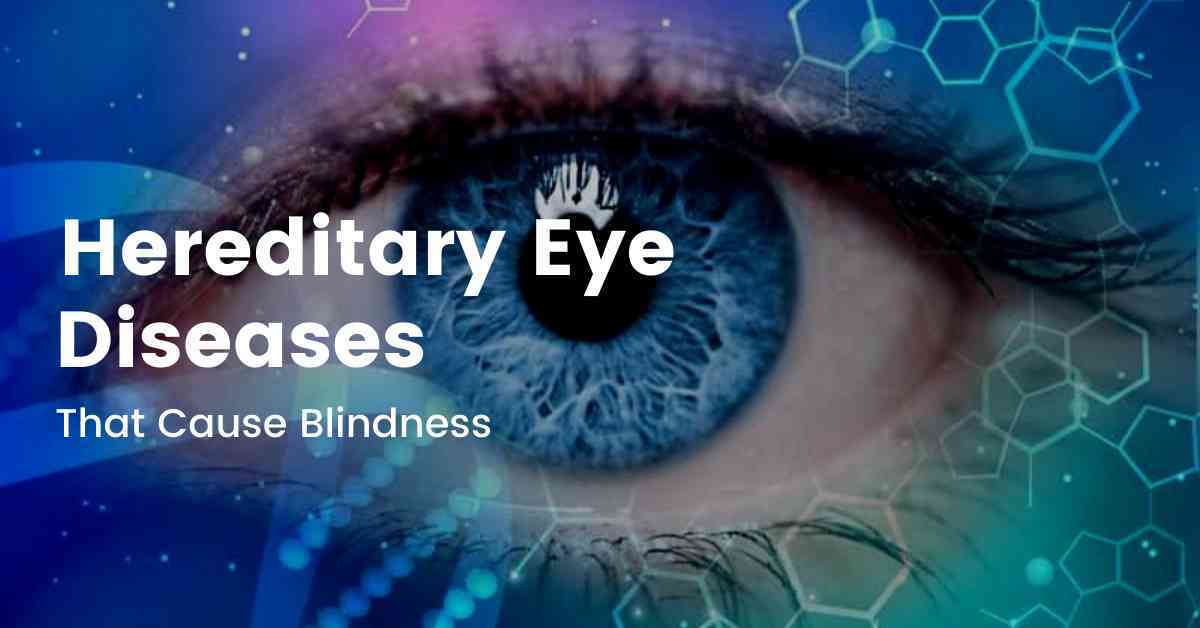 hereditary-eye-diseases-that-cause-blindness-eyesopt