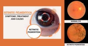 Read more about the article Retinitis Pigmentosa Treatment, Symptoms, And Causes