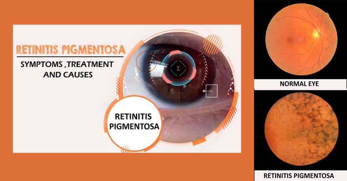 people with retinitis pigmentosa