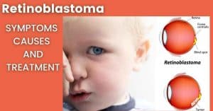 Read more about the article Retinoblastoma Symptoms, Causes, and treatment