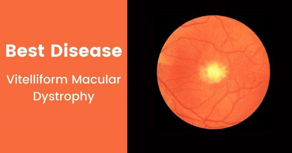 What is the best disease of the eye? (Vitelliform Macular Dystrophy ...