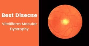 Read more about the article What is the best disease of the eye? (Vitelliform Macular Dystrophy)