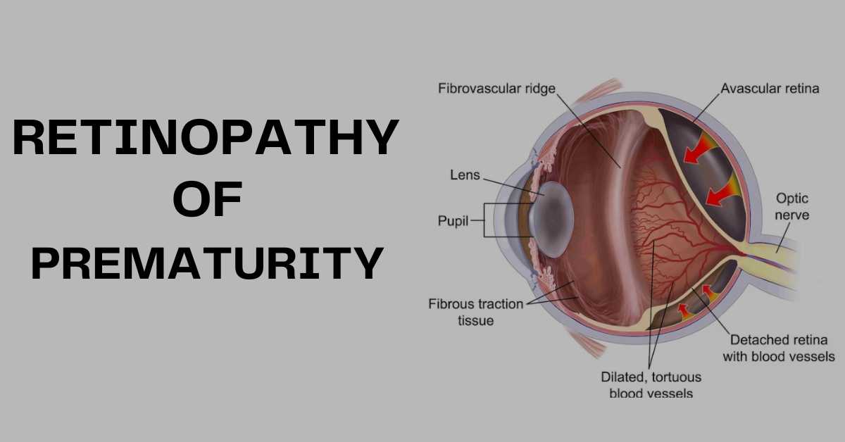 retinopathy of prematurity