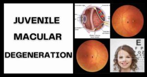 Read more about the article Juvenile Macular Degeneration