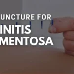 Acupuncture For Retinitis Pigmentosa: Exploring The Potential